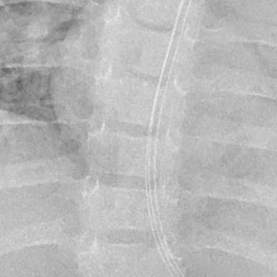 Traitement conventionnel