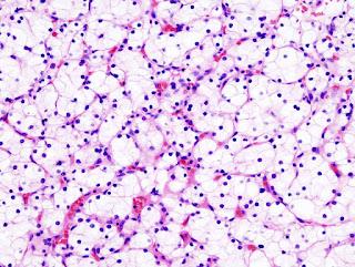 #thelancetoncology #carcinomerénal #nivolumab #ipilimumab #VEGFR-TKI Le nivolumab, le nivolumab–ipilimumab et les inhibiteurs de la VEGFR-tyrosine kinase comme traitement de première ligne du carcinome rénal à cellules claires métastatique (BIONIKK) : ...