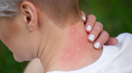 Allergie aux piqûres d’insecte : symptômes, traitements
