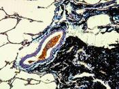 PNEUMOCONIOSE autre grande nuisance charbon