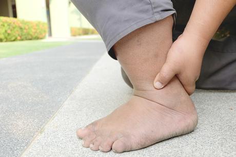 On a longtemps pensé que l'obésité pouvait être un facteur protecteur contre les fractures (Visuel Adobe Stock 219667537) On a longtemps pensé que l'obésité pouvait être un facteur protecteur contre les fractures (Visuel Adobe Stock 219667537)