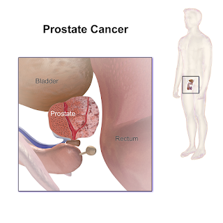 #thelancetoncology #cancerdelaprostate #énergiedesultrasonsfocalisés Thérapie par énergie des ultrasons focalisés guidés par IRM pour les patients atteints d'un cancer de la prostate à risque intermédiaire : une étude multicentrique de phase 2b