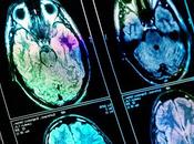 Maladie d’ALZHEIMER seule scintigraphie pour diagnostiquer
