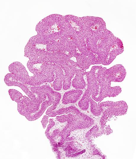 L'immunothérapie après une chirurgie du cancer de la vessie montre d'excellents taux de survie sans cancer (Visuel Adobe Stock 29642937) L'immunothérapie après une chirurgie du cancer de la vessie montre d'excellents taux de survie sans cancer (Visuel Adobe Stock 29642937)