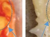 ATHÉROSCLÉROSE laser vaporise plaque