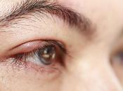 Comment guérir rapidement d’un chalazion