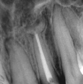 Processus de guérison des kystes périapicaux sans chirurgie