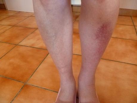 Morsure/Piqûre TAON lundi 12.09.022 morsure,piqure insecte,taon,nature,jardin,été