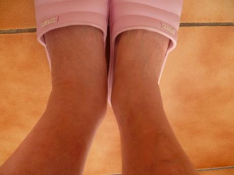 Morsure/Piqûre TAON lundi 12.09.022 morsure,piqure insecte,taon,nature,jardin,été