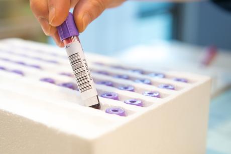 Cette petite protéine, la prostasine, est documentée comme un marqueur sanguin, prédictif de diabète et de décès par cancer (Visue Adobe Stock 61724653) Cette petite protéine, la prostasine, est documentée comme un marqueur sanguin, prédictif de diabète et de décès par cancer (Visue Adobe Stock 61724653)