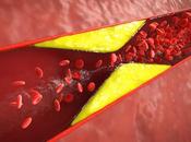 MALADIE CARDIAQUE ATIC, nouvelle cible pour prévenir