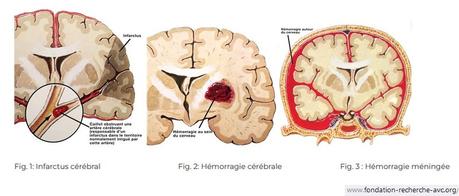 L'AVC de Pierre Palmade