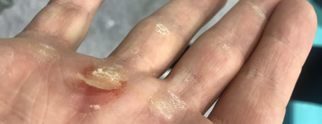 callosité main traction