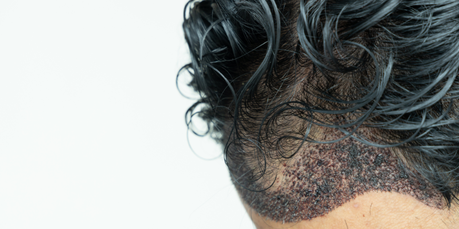 Greffe de cheveux en Turquie : l’émergence d’un pôle mondial de la chirurgie capillaire