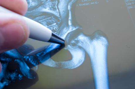 L’incidence des fractures osseuses est en forte progression, les fractures de la hanche pourraient presque doubler d'ici 2050 (Visuel Adobe Stock 146660430)